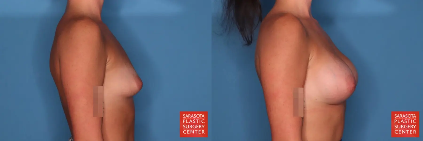 Motiva Implants: Patient 2 - Before and After 5