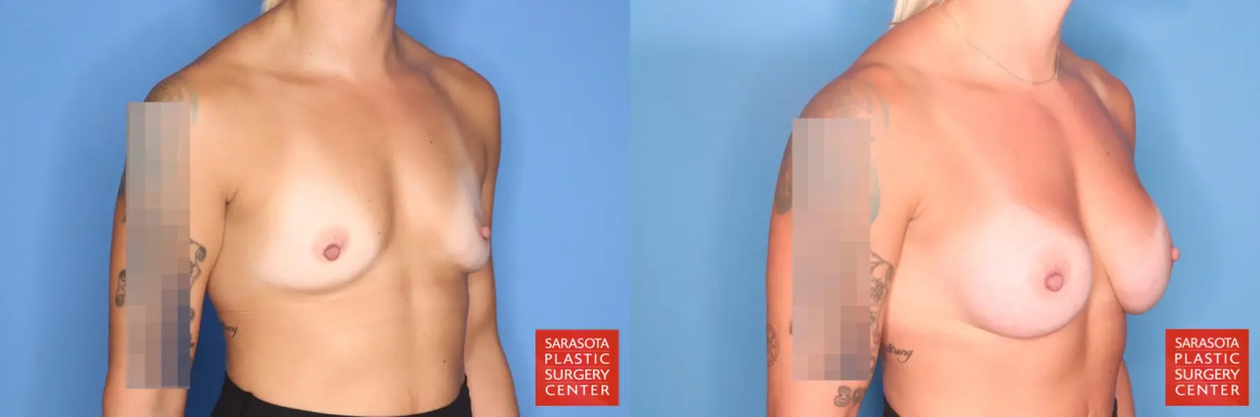 Motiva Implants: Patient 1 - Before and After 4