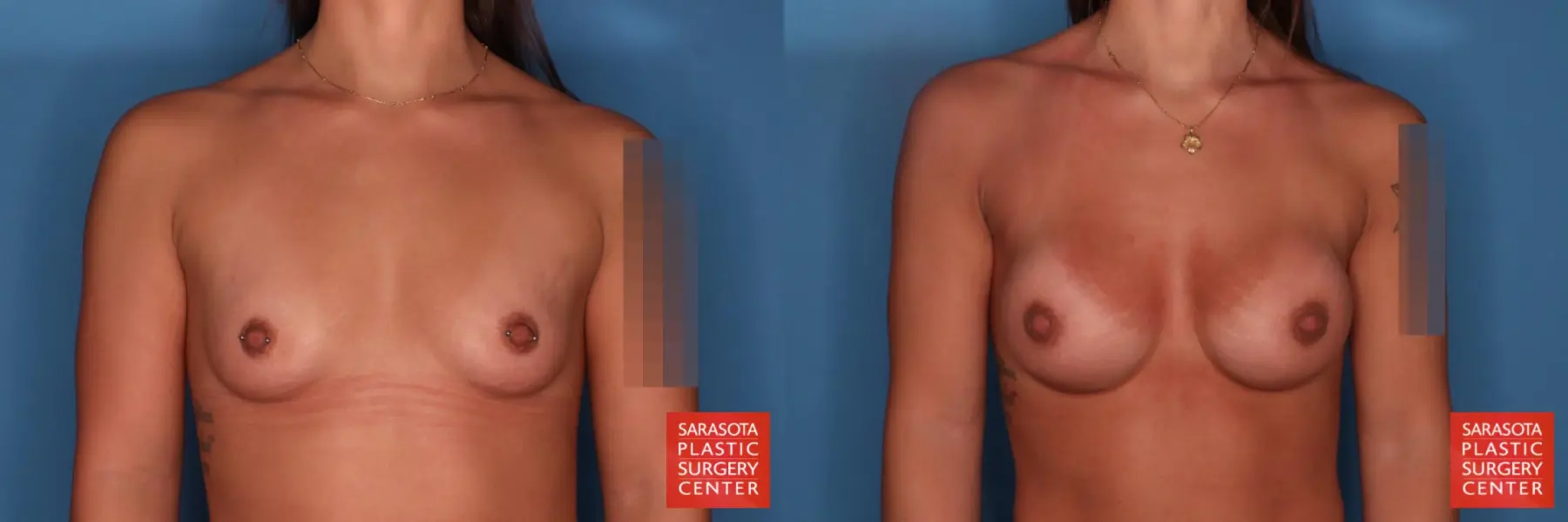 Motiva Implants: Patient 3 - Before and After