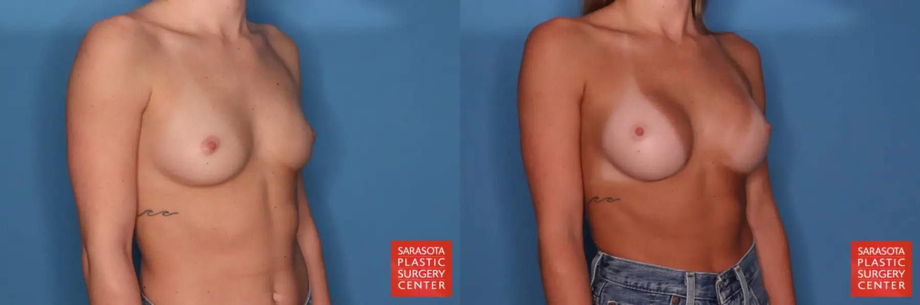 Motiva Implants: Patient 11 - Before and After 4