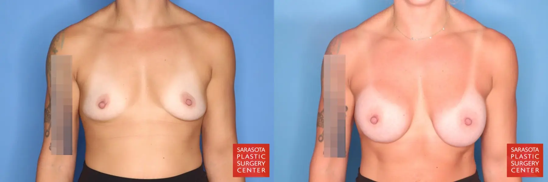 Motiva Implants: Patient 1 - Before and After