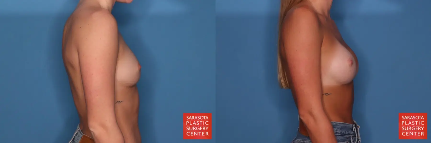 Motiva Implants: Patient 11 - Before and After 5