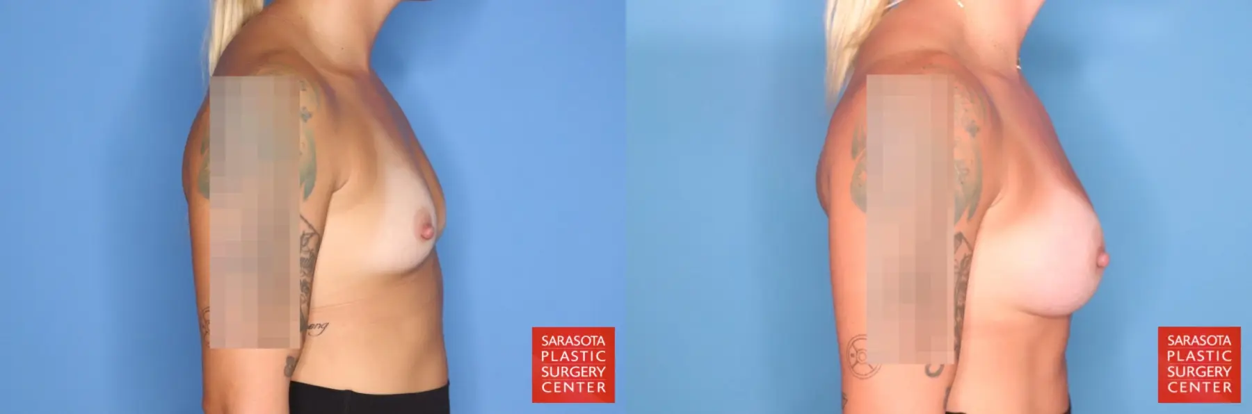 Motiva Implants: Patient 1 - Before and After 5