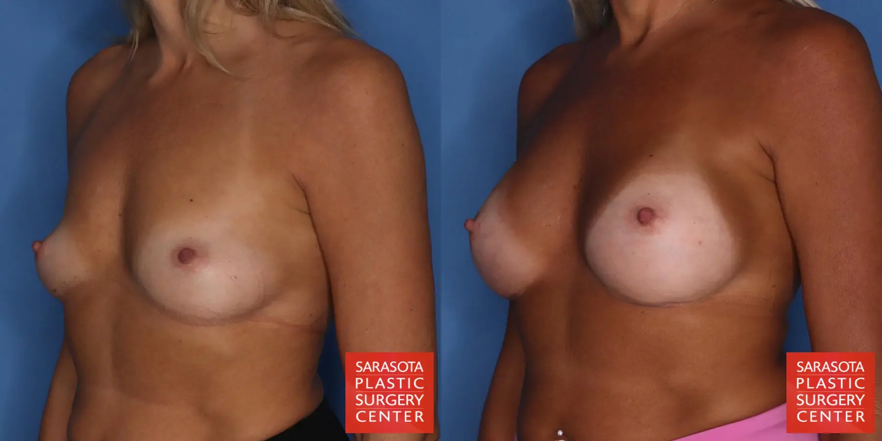 Motiva Implants: Patient 10 - Before and After 4