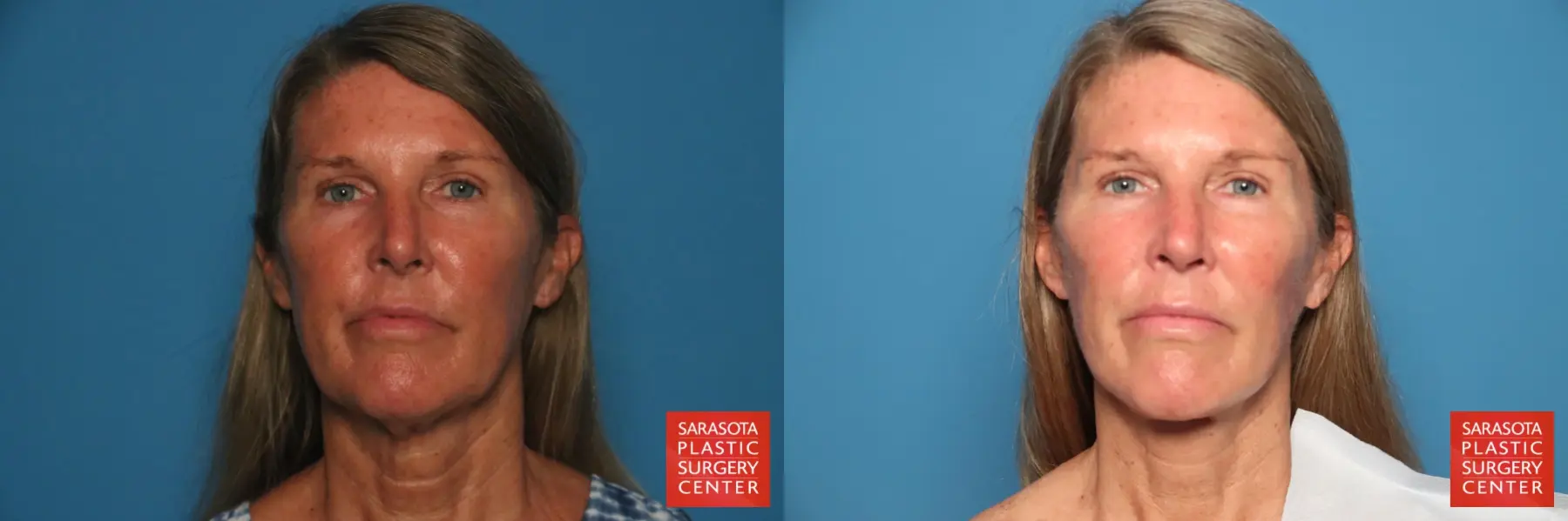 Neck Lift: Patient 6 - Before and After  