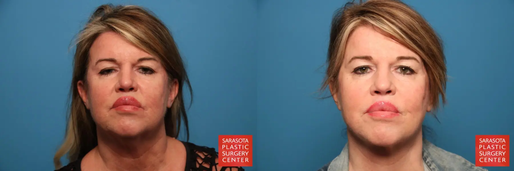 Neck Lift: Patient 4 - Before and After 1