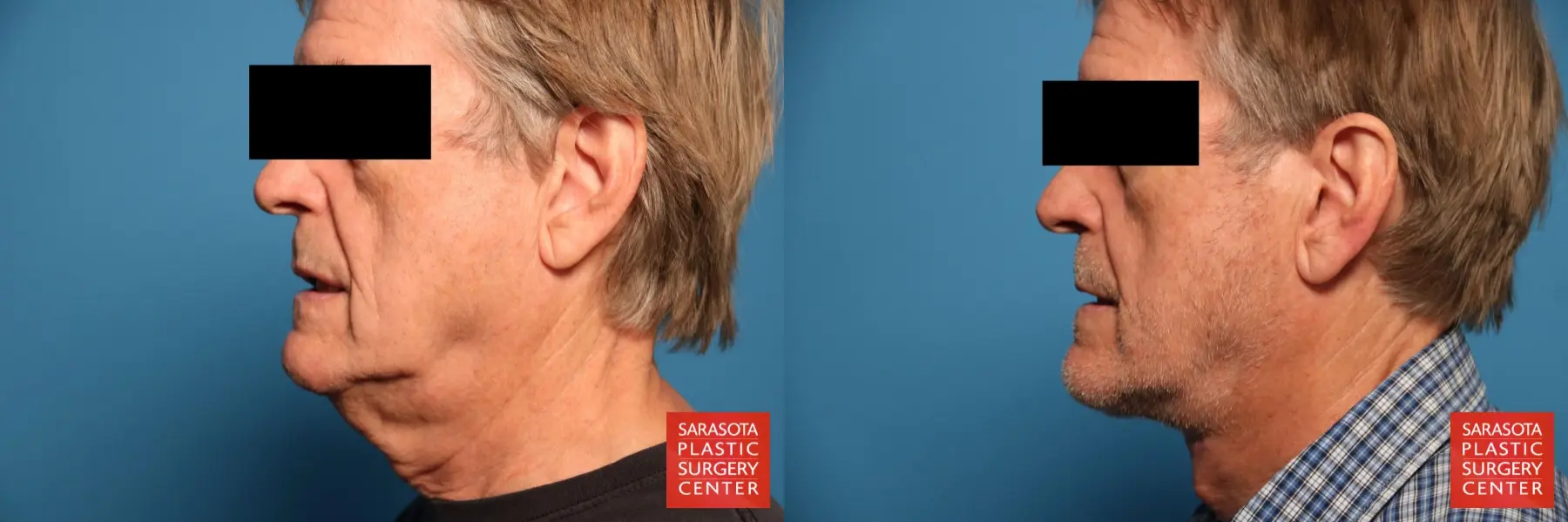 Neck Lift: Patient 7 - Before and After 3