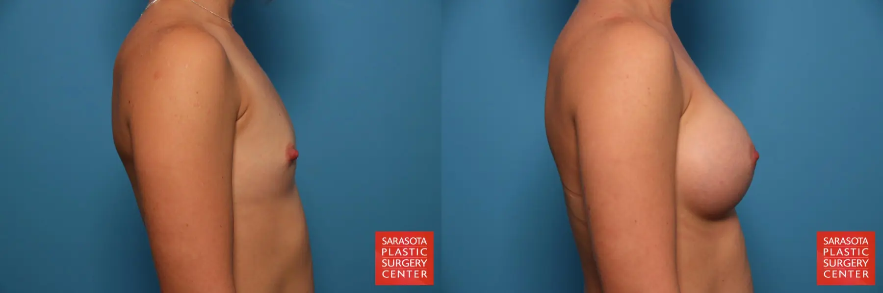 Nipple Reduction: Patient 2 - Before and After 3