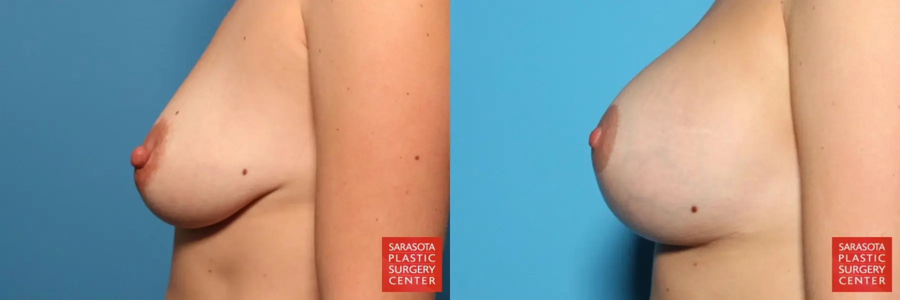 Nipple Reduction: Patient 1 - Before and After 3