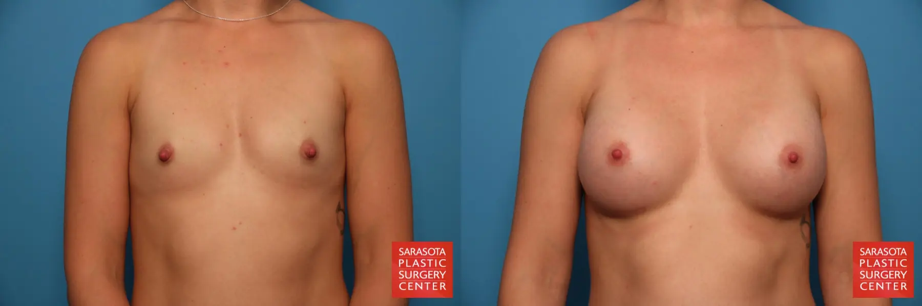 Nipple Reduction: Patient 2 - Before and After  
