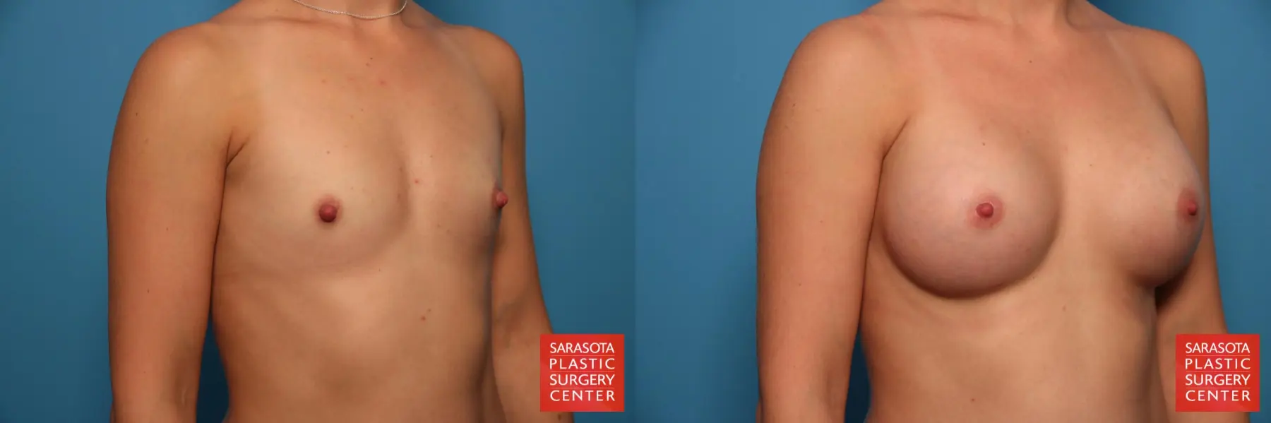Nipple Reduction: Patient 2 - Before and After 2