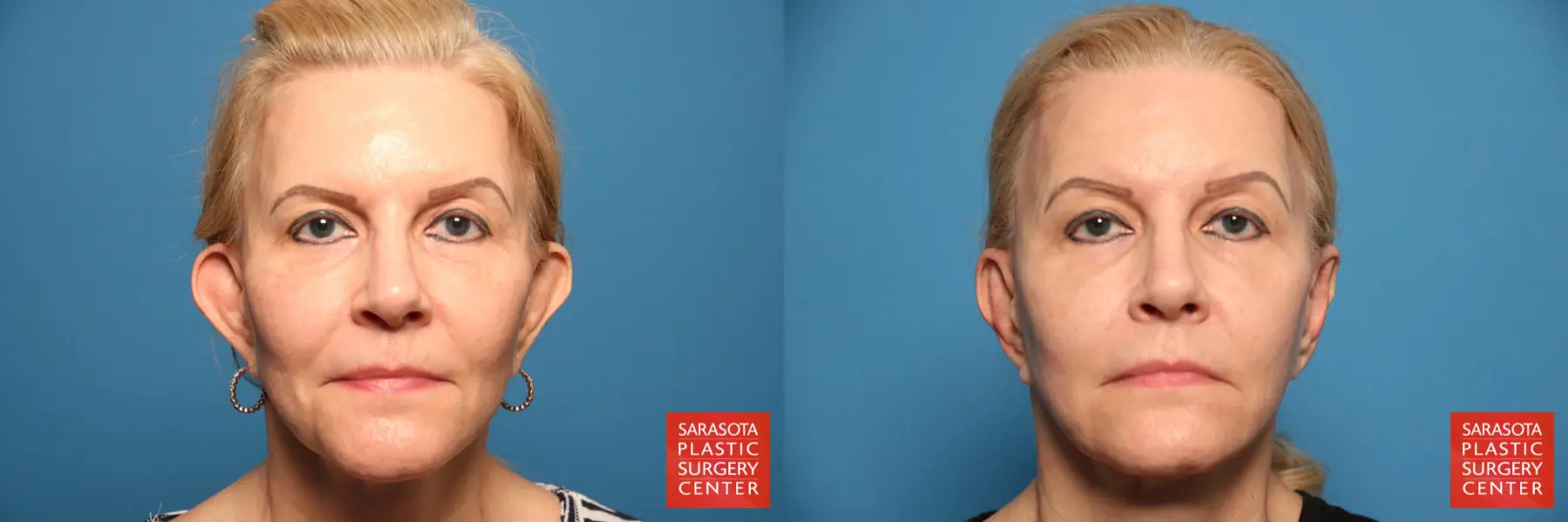Otoplasty And Earlobe Repair: Patient 1 - Before and After  