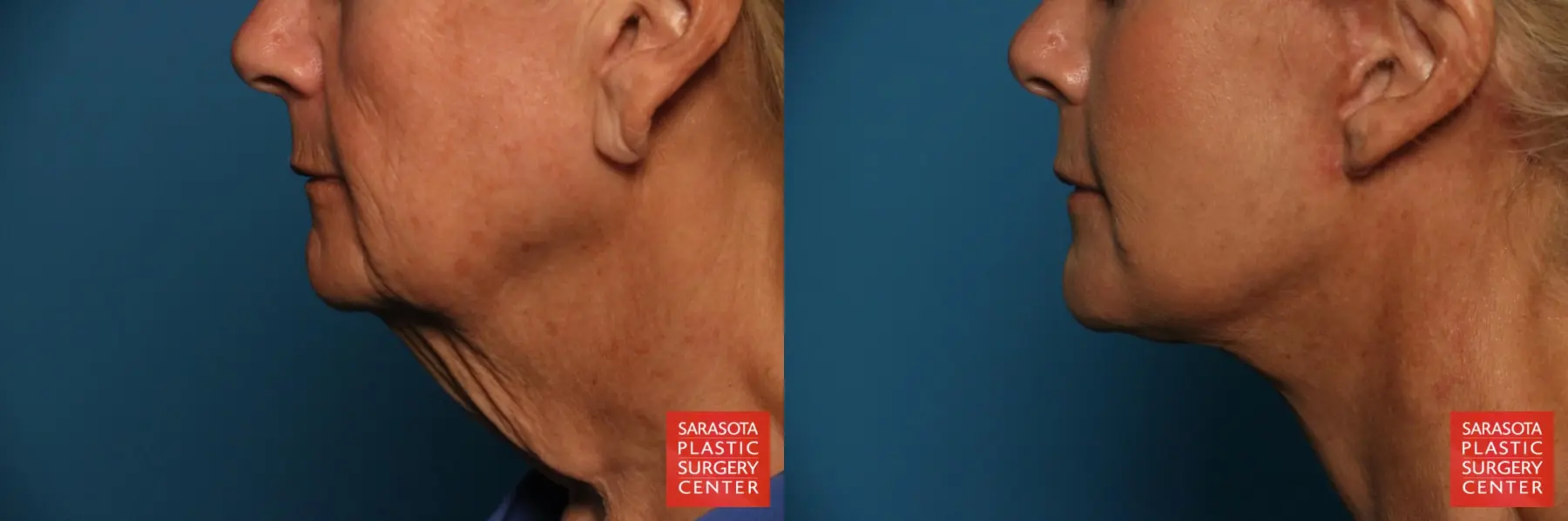 Otoplasty And Earlobe Repair: Patient 5 - Before and After  