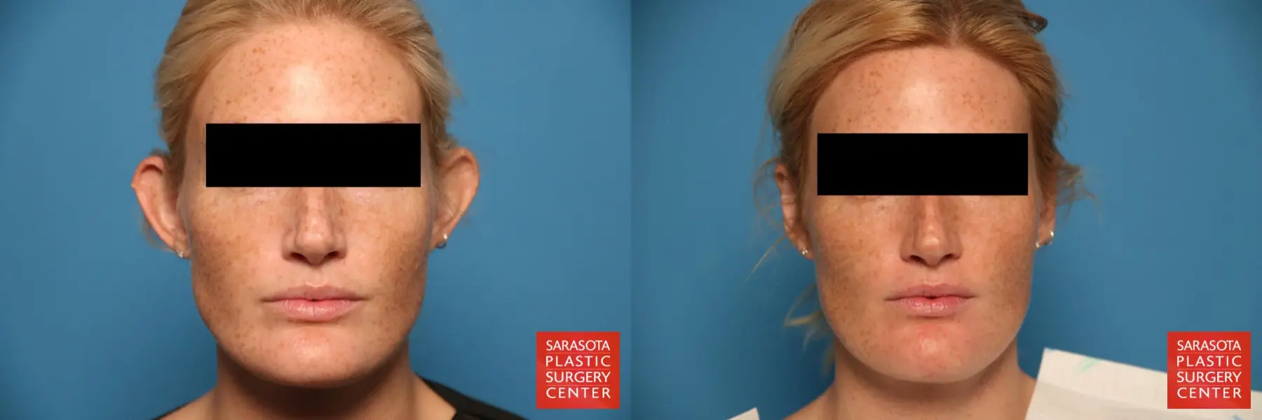 Otoplasty And Earlobe Repair: Patient 2 - Before and After  