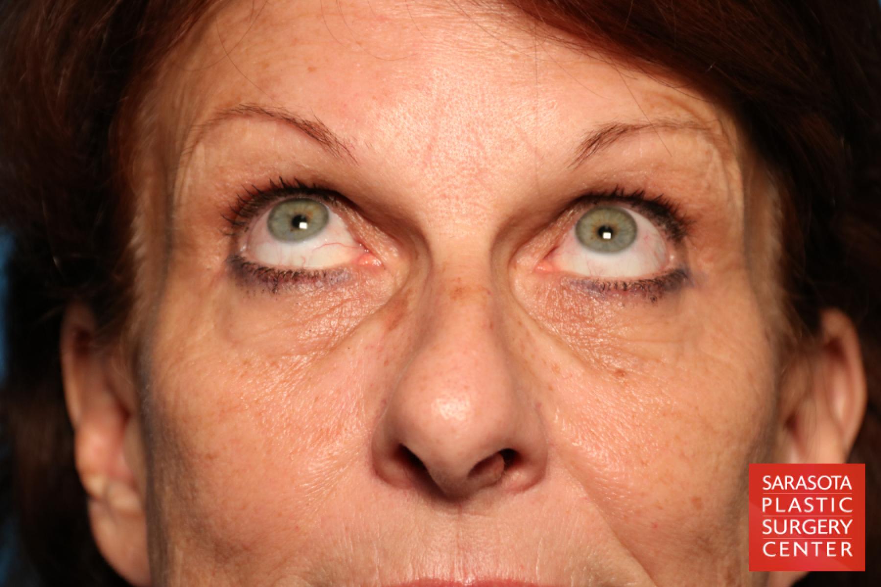 Eyelid Surgery: Patient 25 - Before 2