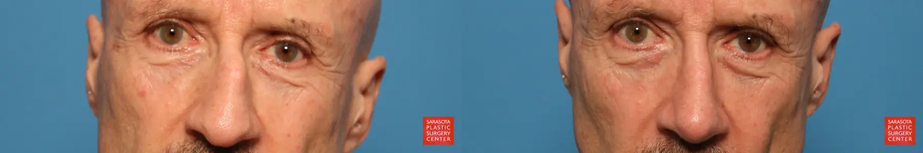 Rhinoplasty: Patient 22 - Before and After  