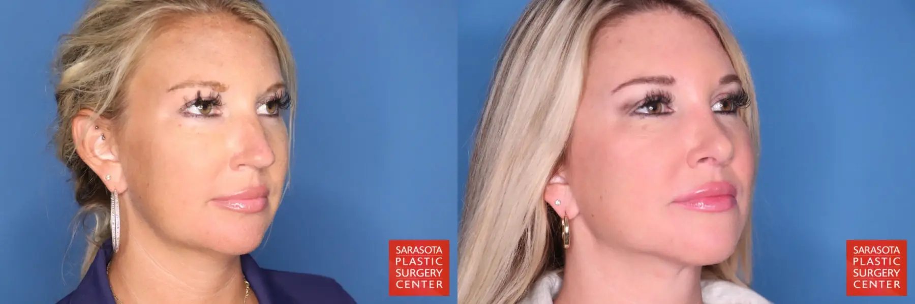 Rhinoplasty: Patient 23 - Before and After 4