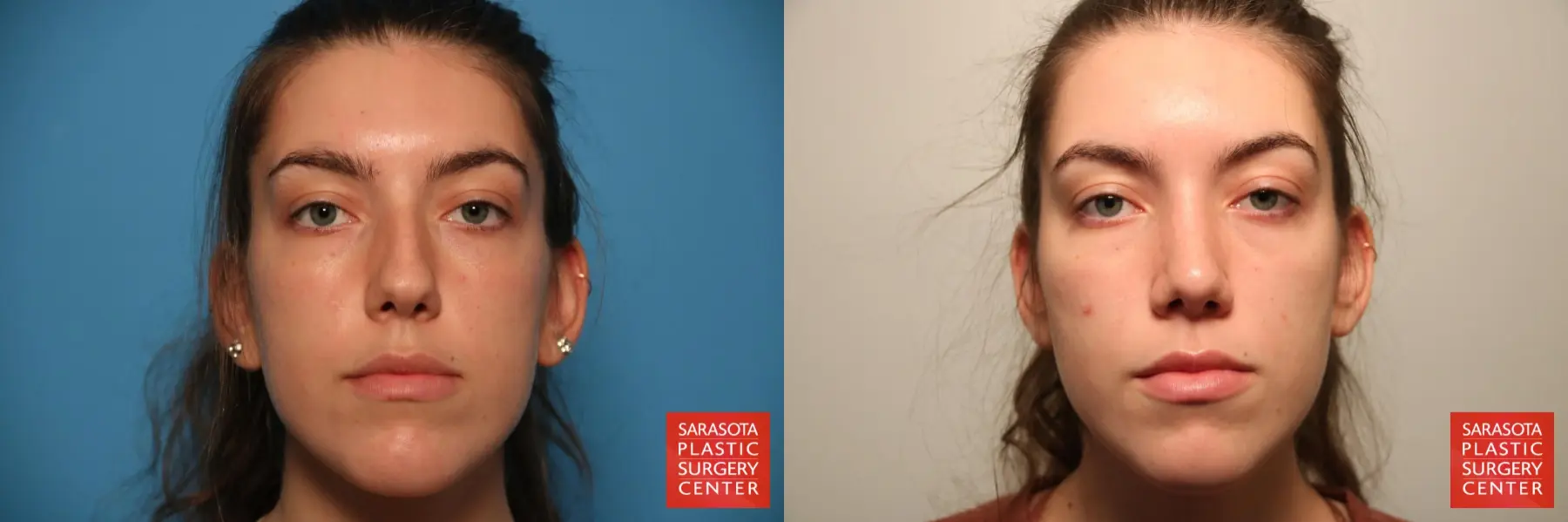 Rhinoplasty: Patient 16 - Before and After  