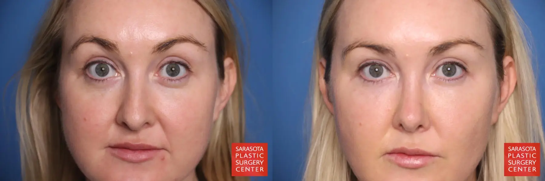 Rhinoplasty: Patient 4 - Before and After 2
