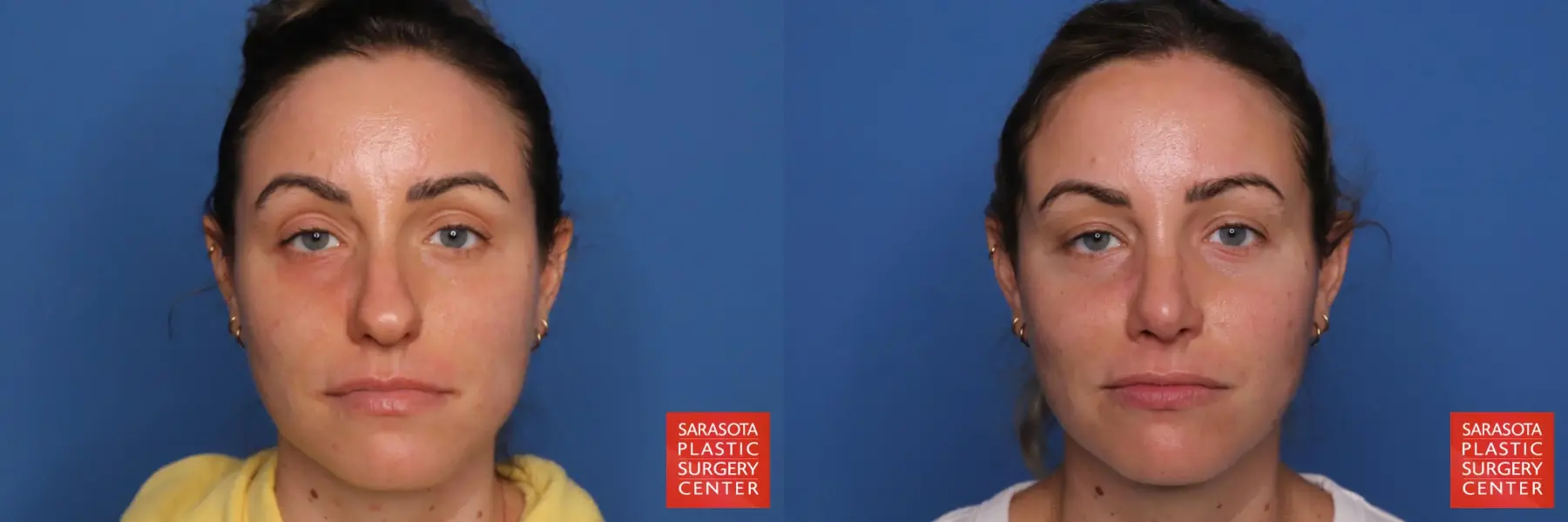 Rhinoplasty: Patient 32 - Before and After  