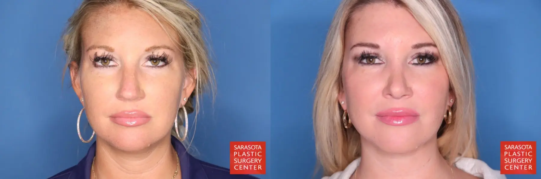 Rhinoplasty: Patient 23 - Before and After  