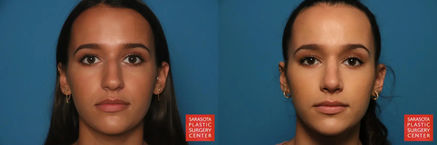 Rhinoplasty: Patient 34 - Before and After  