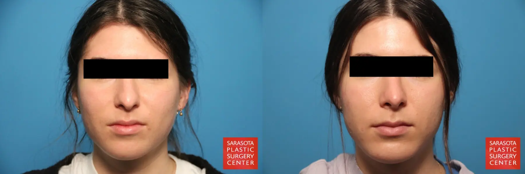 Rhinoplasty: Patient 5 - Before and After  