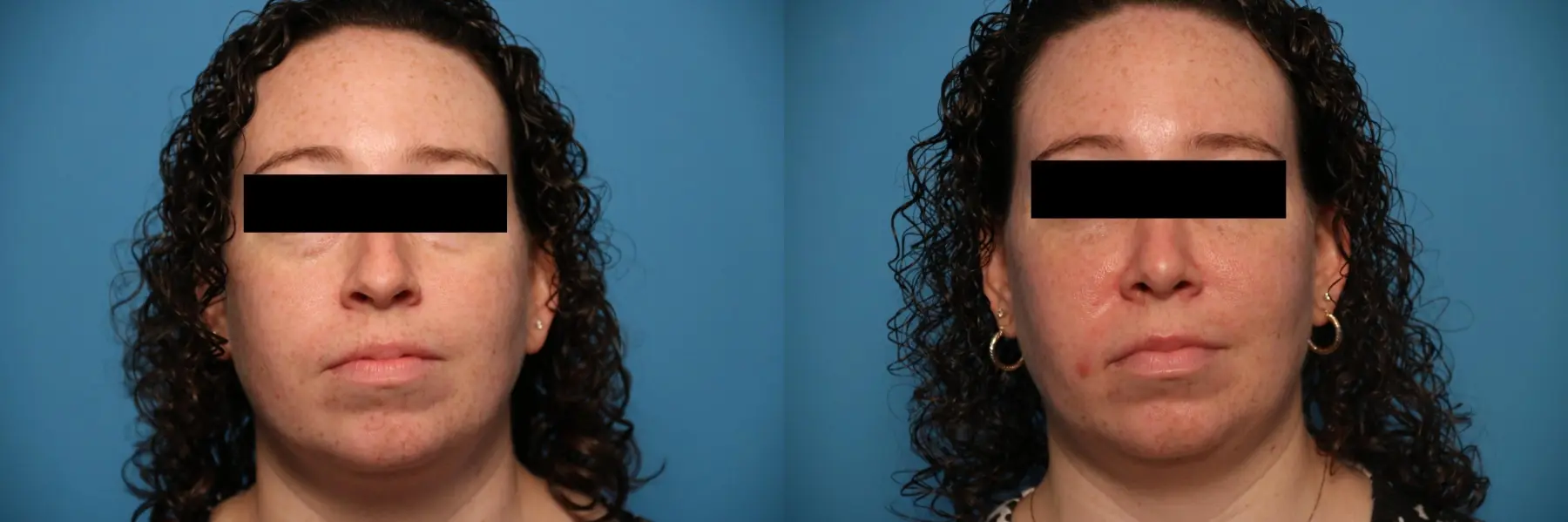 Rhinoplasty: Patient 16 - Before and After  