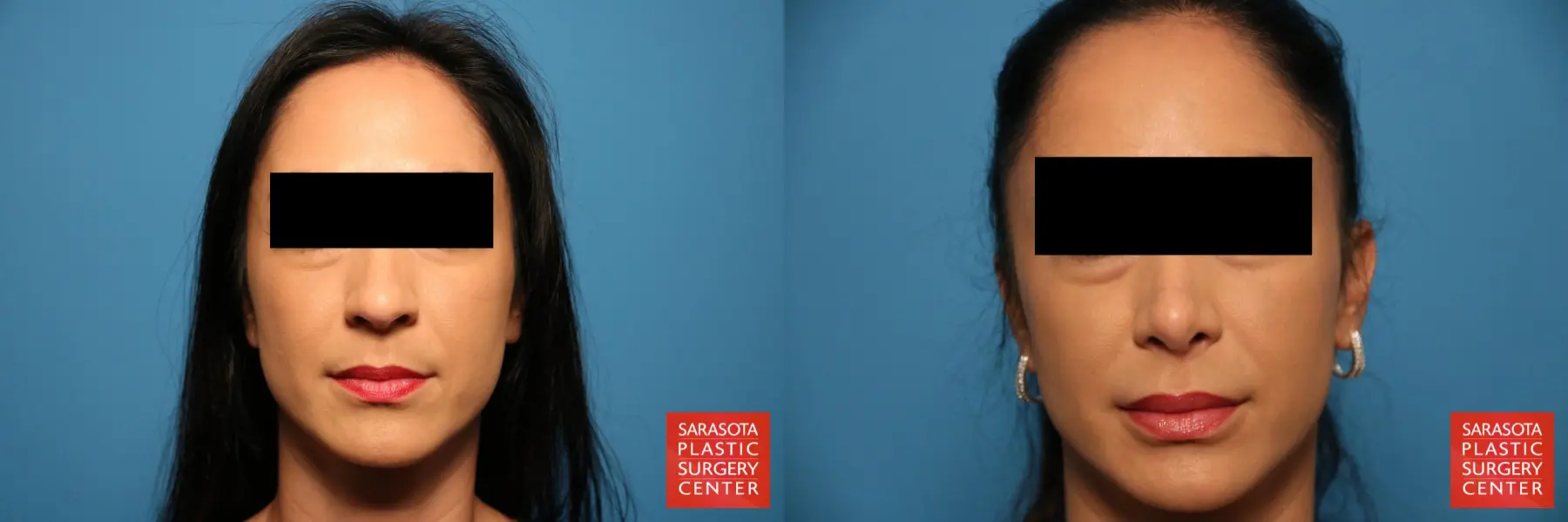 Rhinoplasty: Patient 17 - Before and After  