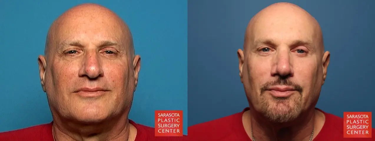 Rhinoplasty: Patient 14 - Before and After  