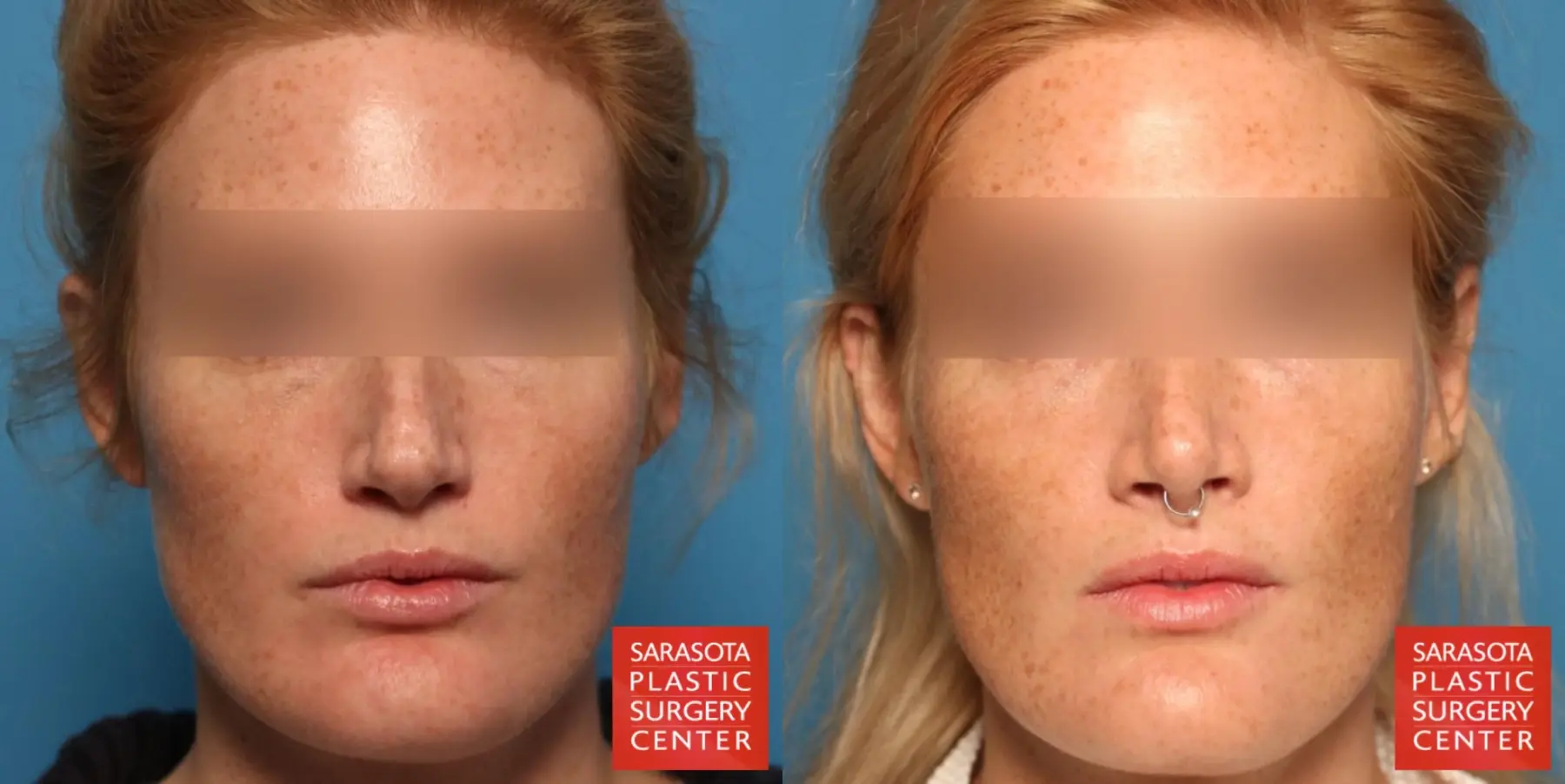 Rhinoplasty: Patient 19 - Before and After  