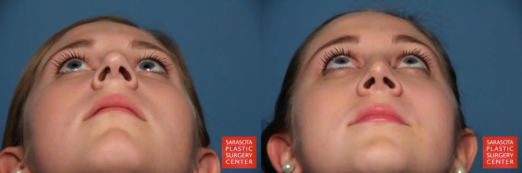 Rhinoplasty: Patient 9 - Before and After 6