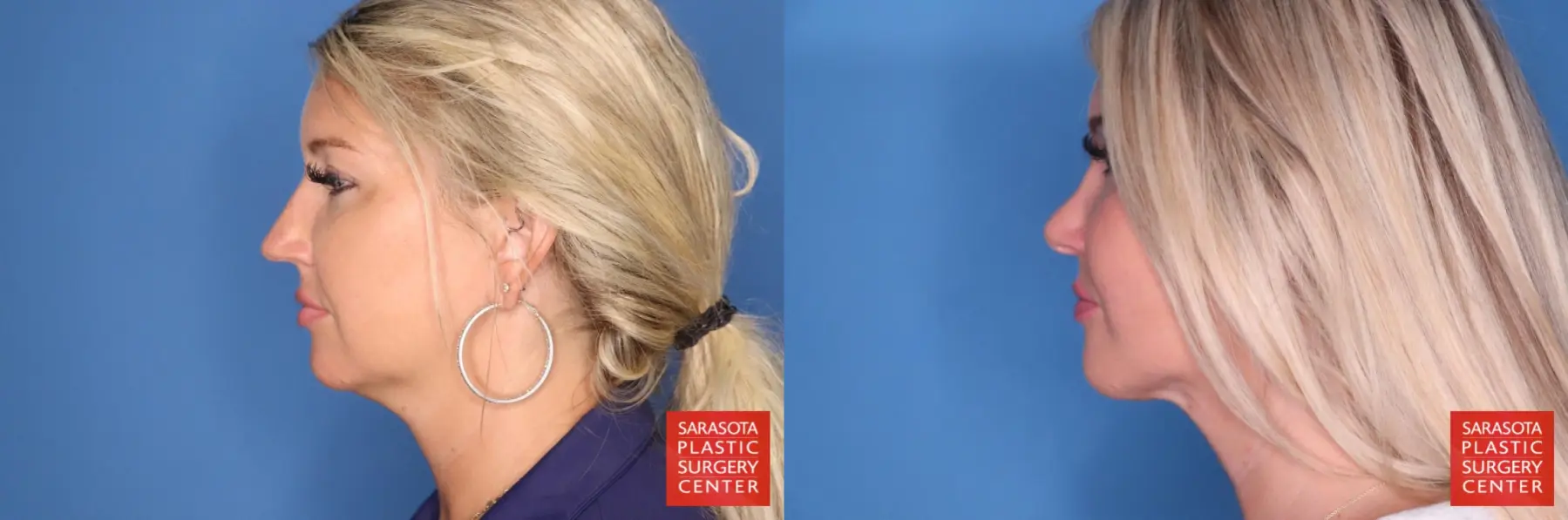 Rhinoplasty: Patient 23 - Before and After 3