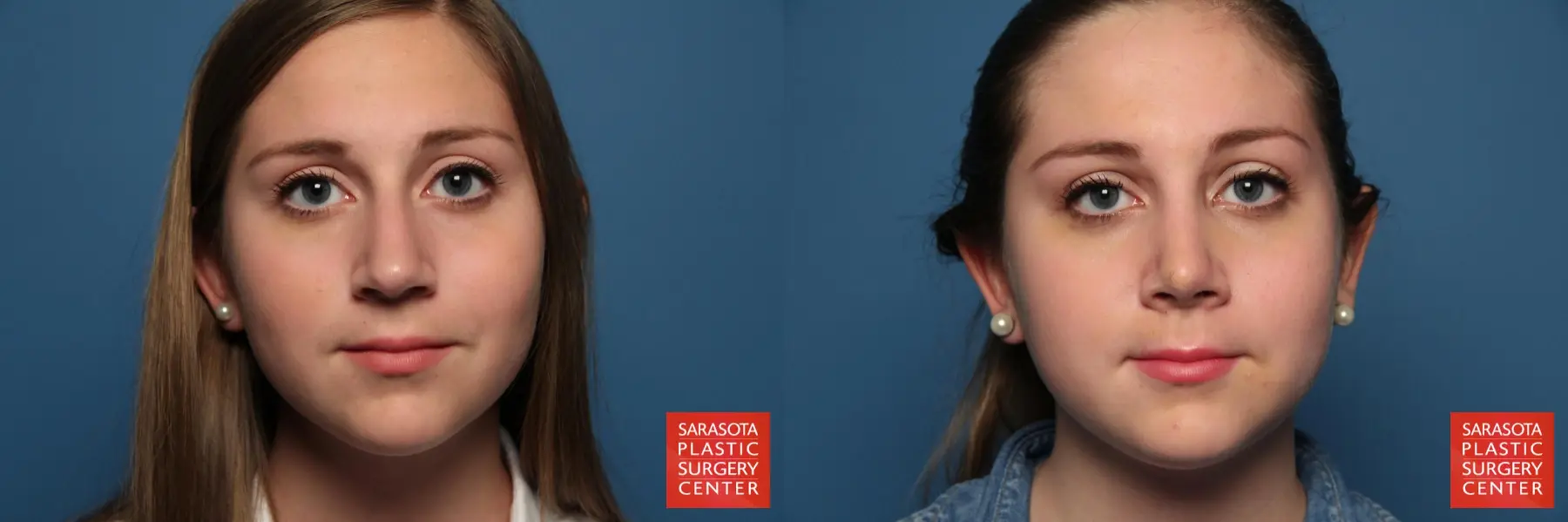 Rhinoplasty: Patient 8 - Before and After  
