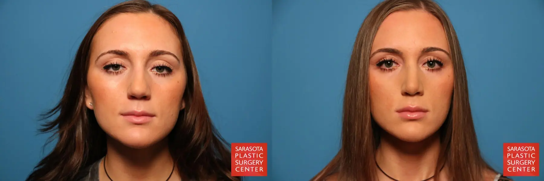 Rhinoplasty: Patient 10 - Before and After  