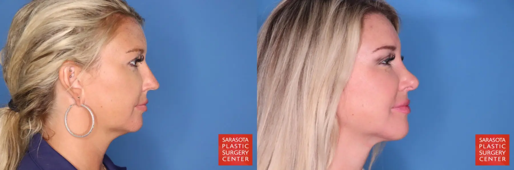 Rhinoplasty: Patient 23 - Before and After 5