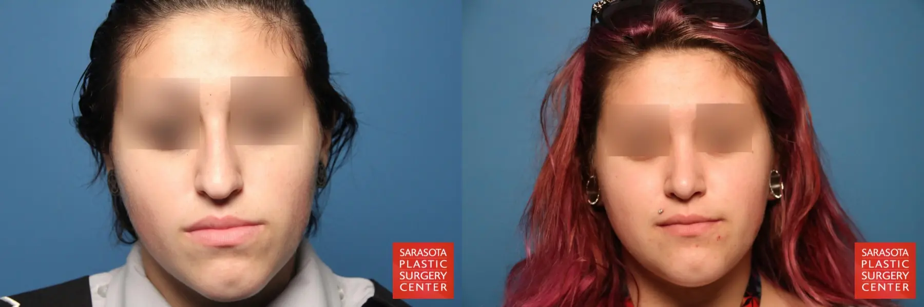 Rhinoplasty: Patient 8 - Before and After  