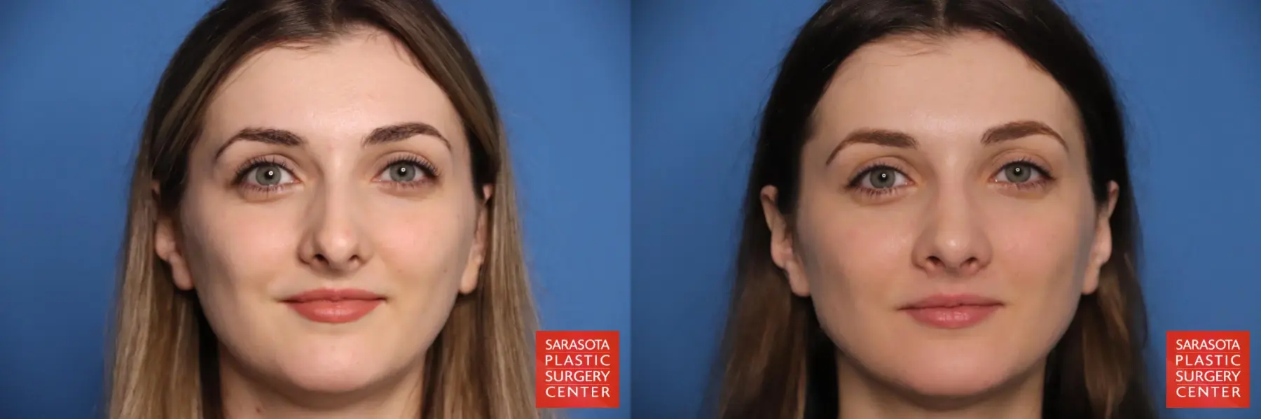 Rhinoplasty: Patient 20 - Before and After  