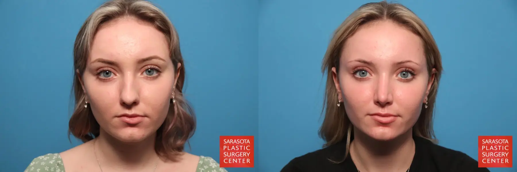 Rhinoplasty: Patient 6 - Before and After  