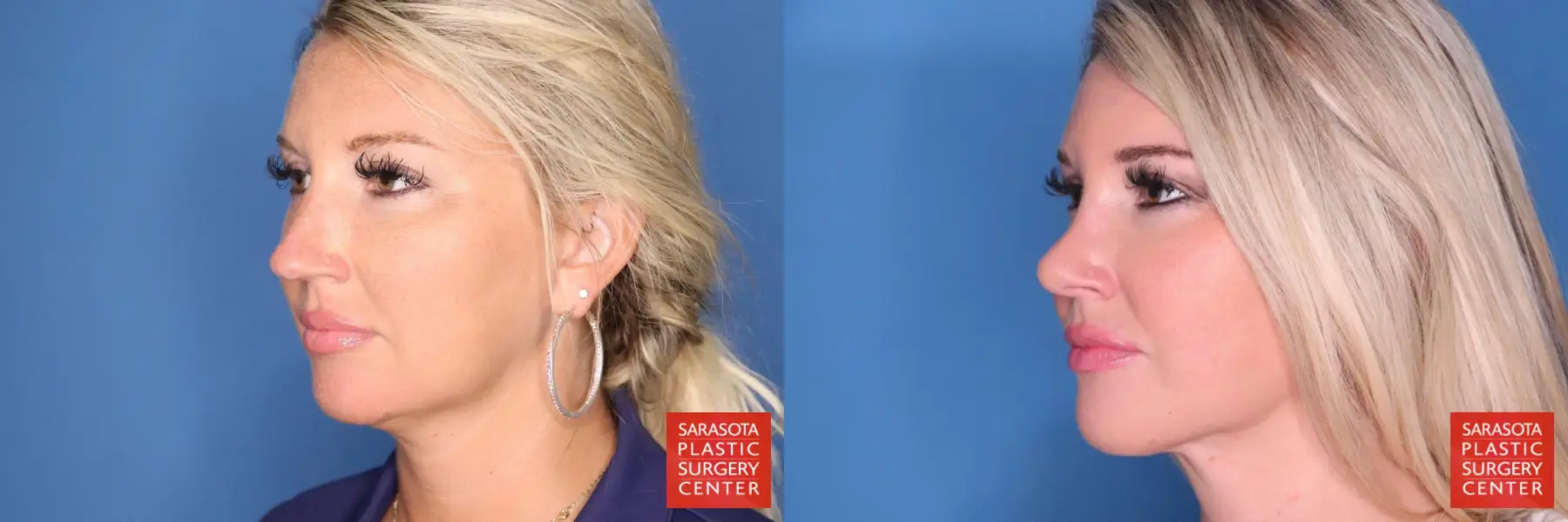 Rhinoplasty: Patient 23 - Before and After 2