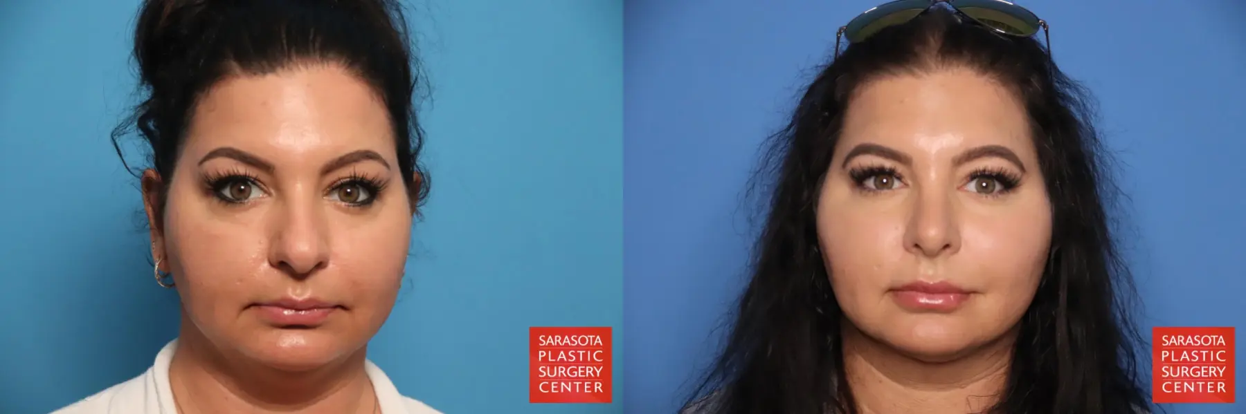 Rhinoplasty: Patient 21 - Before and After  