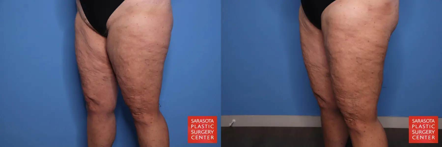 Thigh Lift: Patient 4 - Before and After 2
