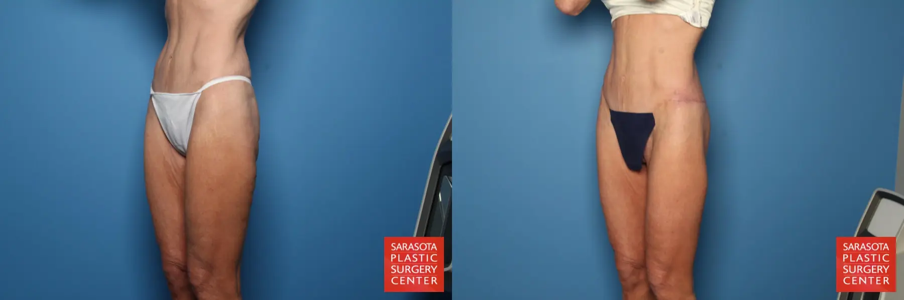 Thigh Lift: Patient 3 - Before and After 2