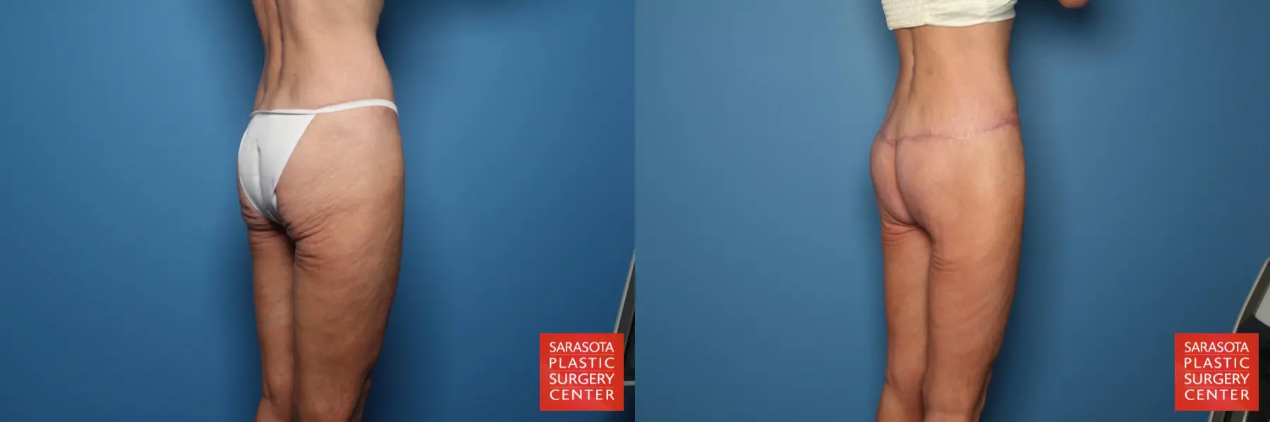 Thigh Lift: Patient 3 - Before and After 4