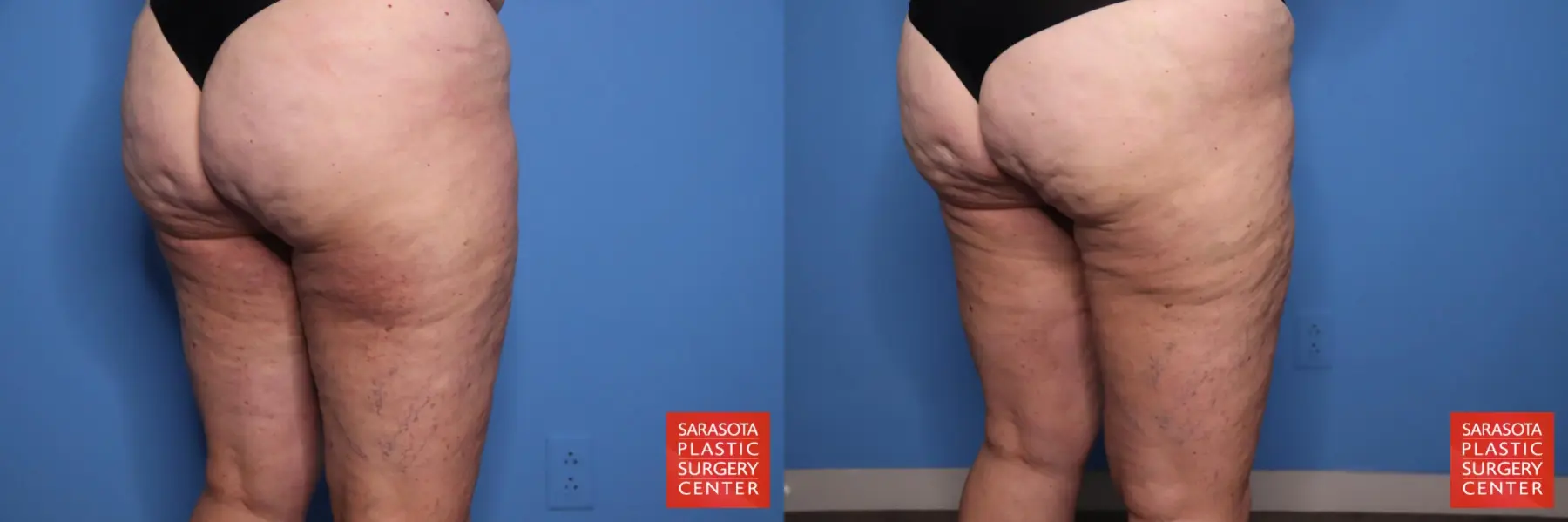 Thigh Lift: Patient 4 - Before and After 4