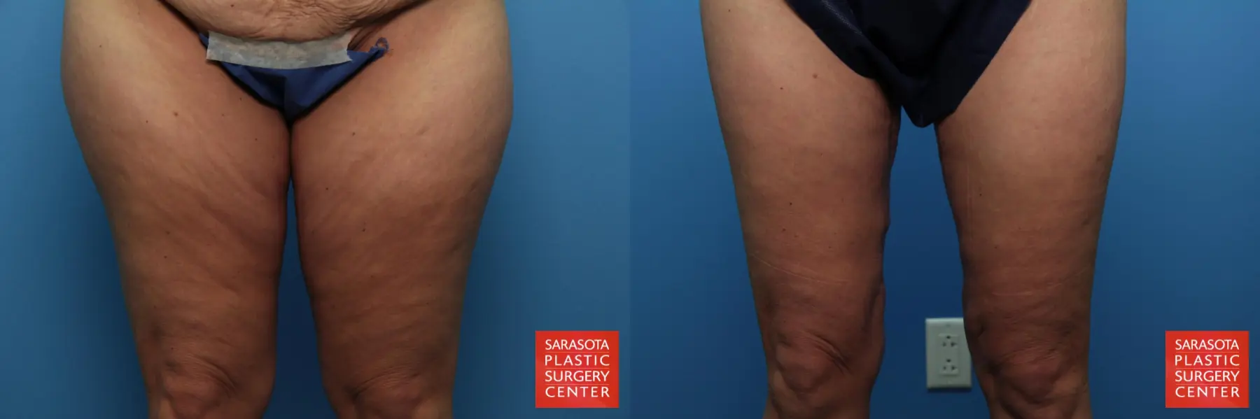 Thigh Lift: Patient 2 - Before and After  