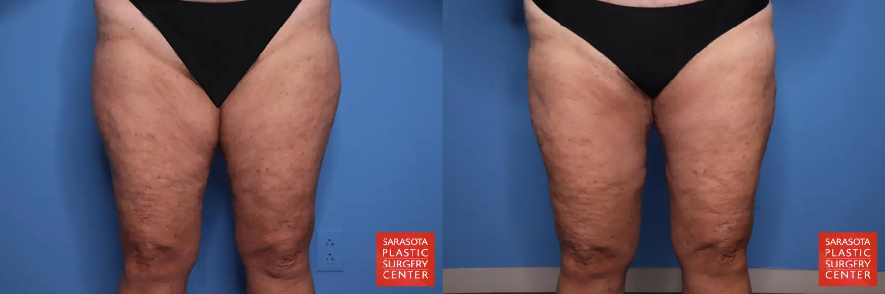 Thigh Lift: Patient 4 - Before and After  