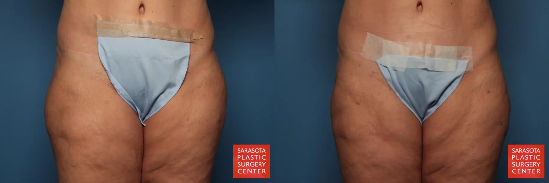 Thigh Lift: Patient 7 - Before and After  