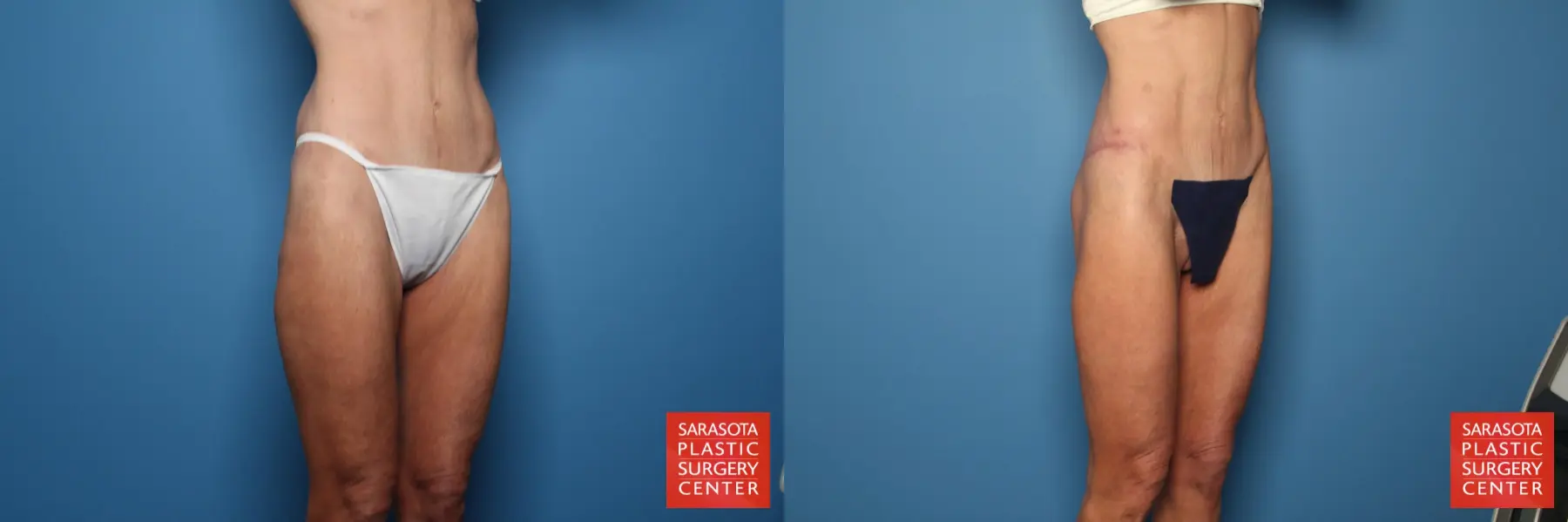 Thigh Lift: Patient 3 - Before and After 3