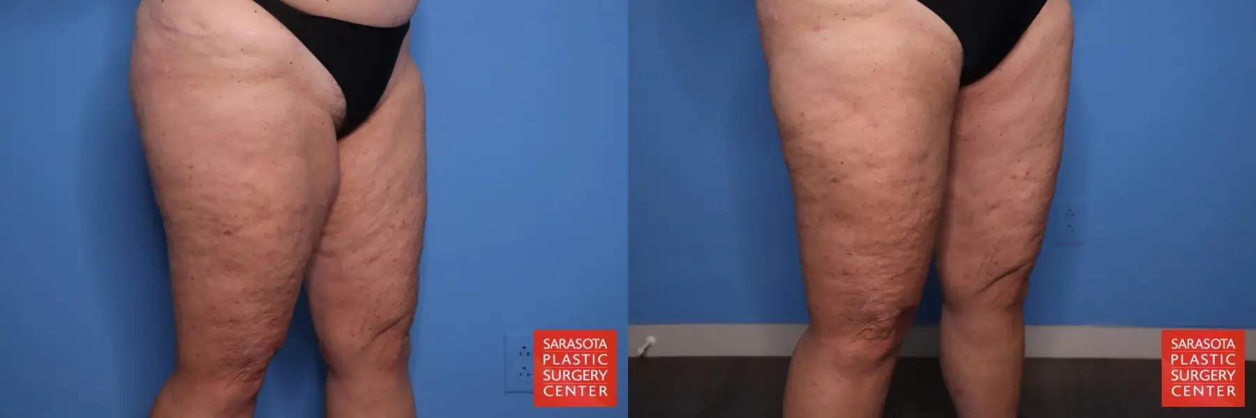 Thigh Lift: Patient 4 - Before and After 3